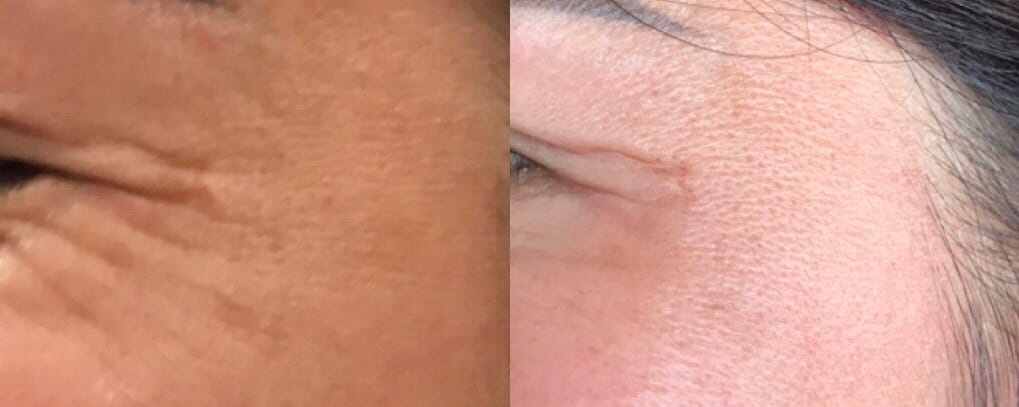 Hình ảnh trước và sau khi tiêm Botox xóa nhăn mắt