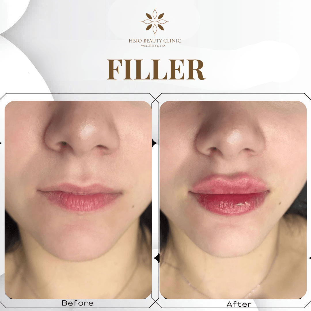 Factors That Influence Lip Filler Prices