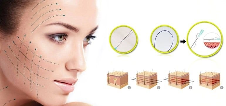 căng chỉ nâng cơ tầng mặt giữa