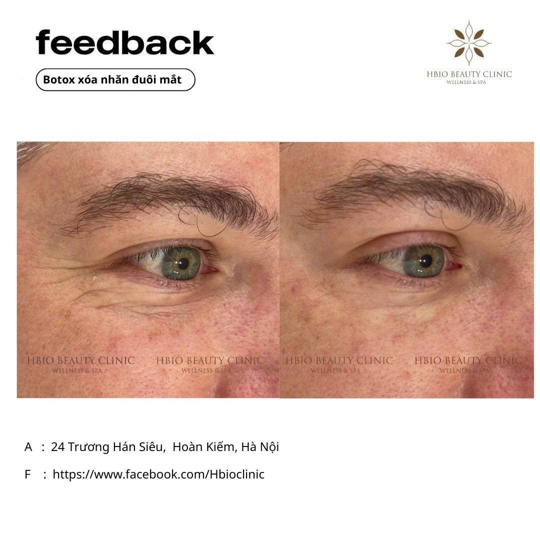 Hình ảnh trước và sau khi tiêm Botox xóa nhăn mắt