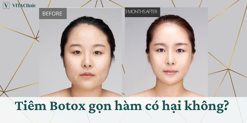 Có nên tiêm gọn hàm không?