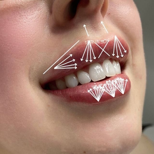 Đánh dấu điểm tiêm và sát khuẩn