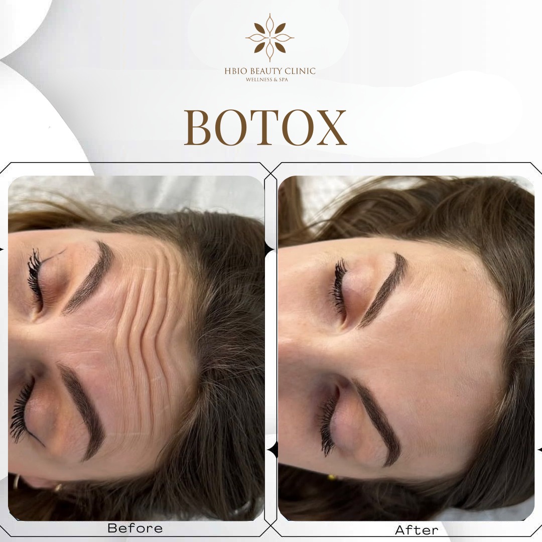 xoá nhăn trán bằng botox