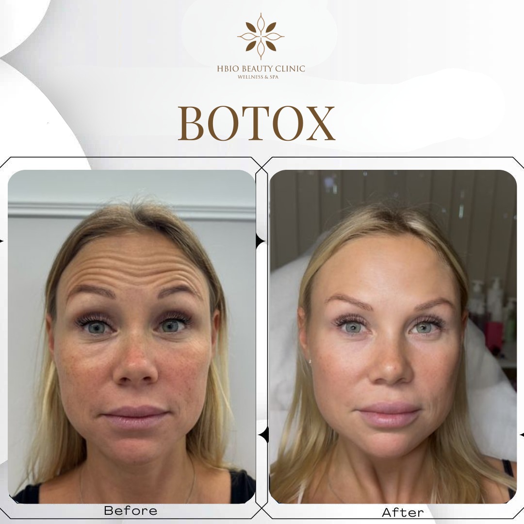xoá nhăn trán bằng botox
