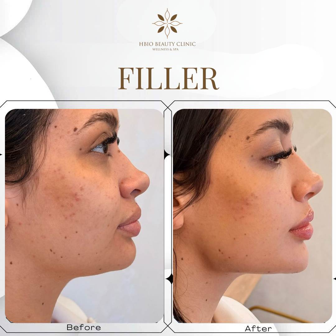 hình ảnh trước và sau khi tiêm cằm