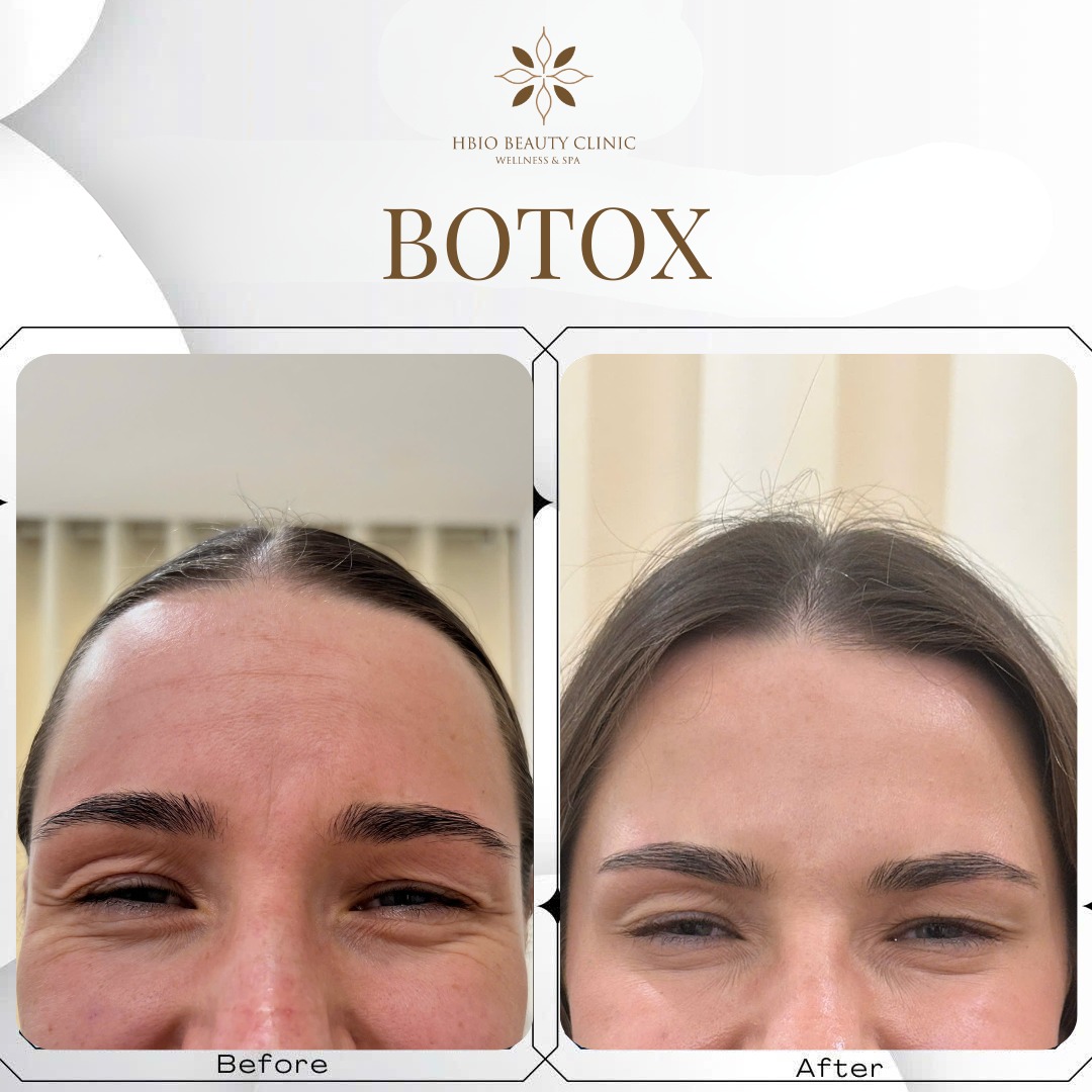 hình ảnh trước và sau xóa nhăn cau mày