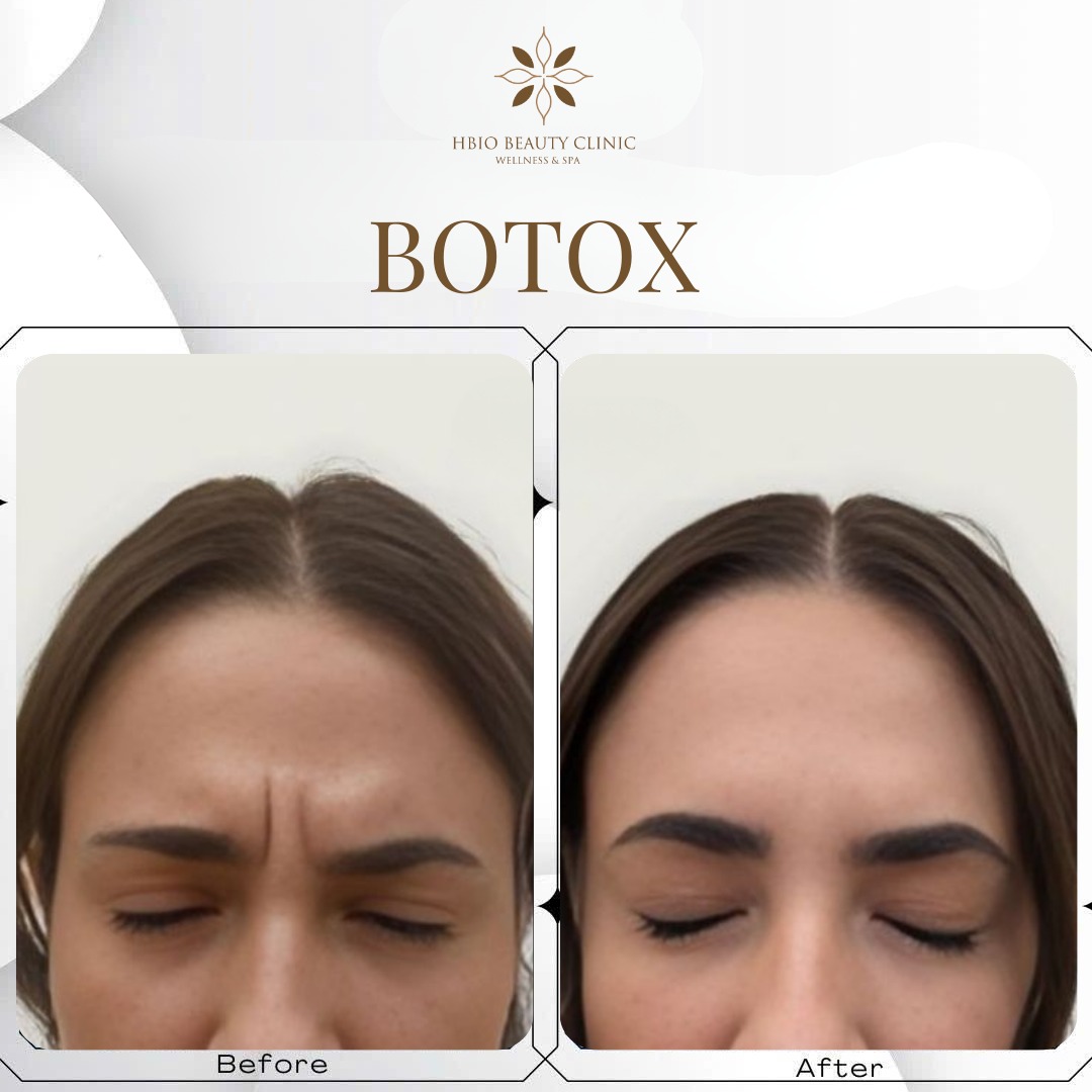 hình ảnh trước và sau xóa nhăn cau mày