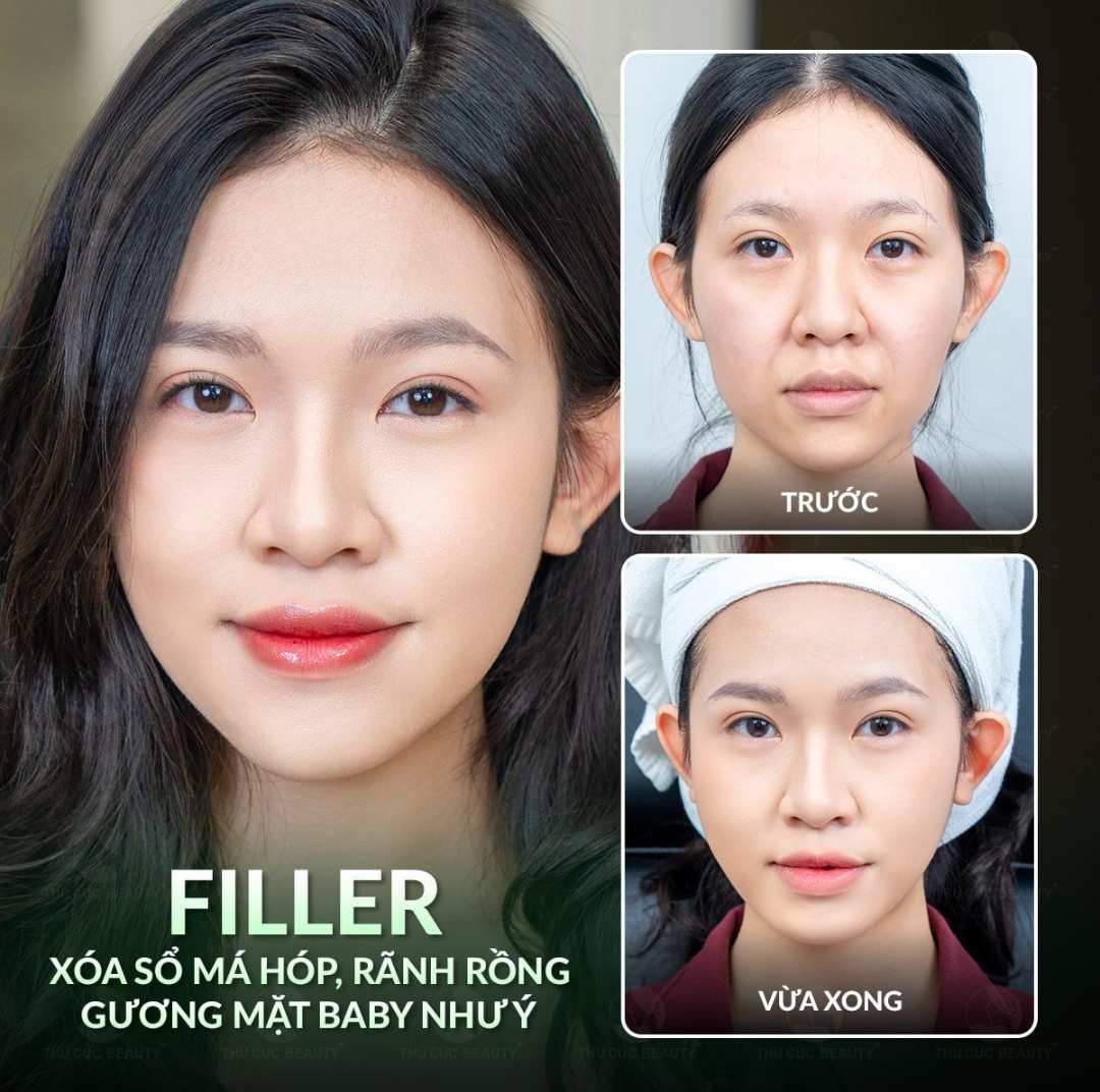 Kết quả tiêm filler má tự nhiên và an toàn