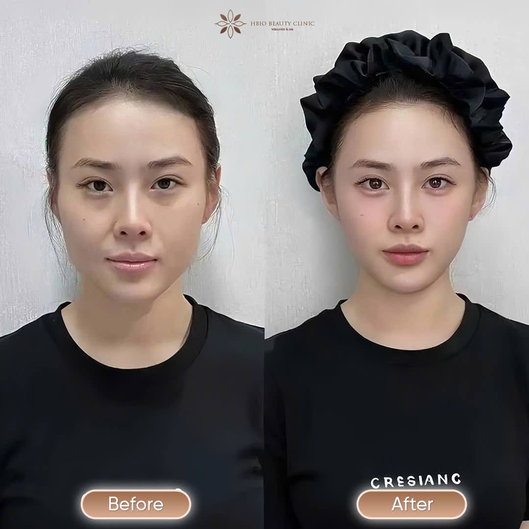 kết quả tiêm filler thái dương