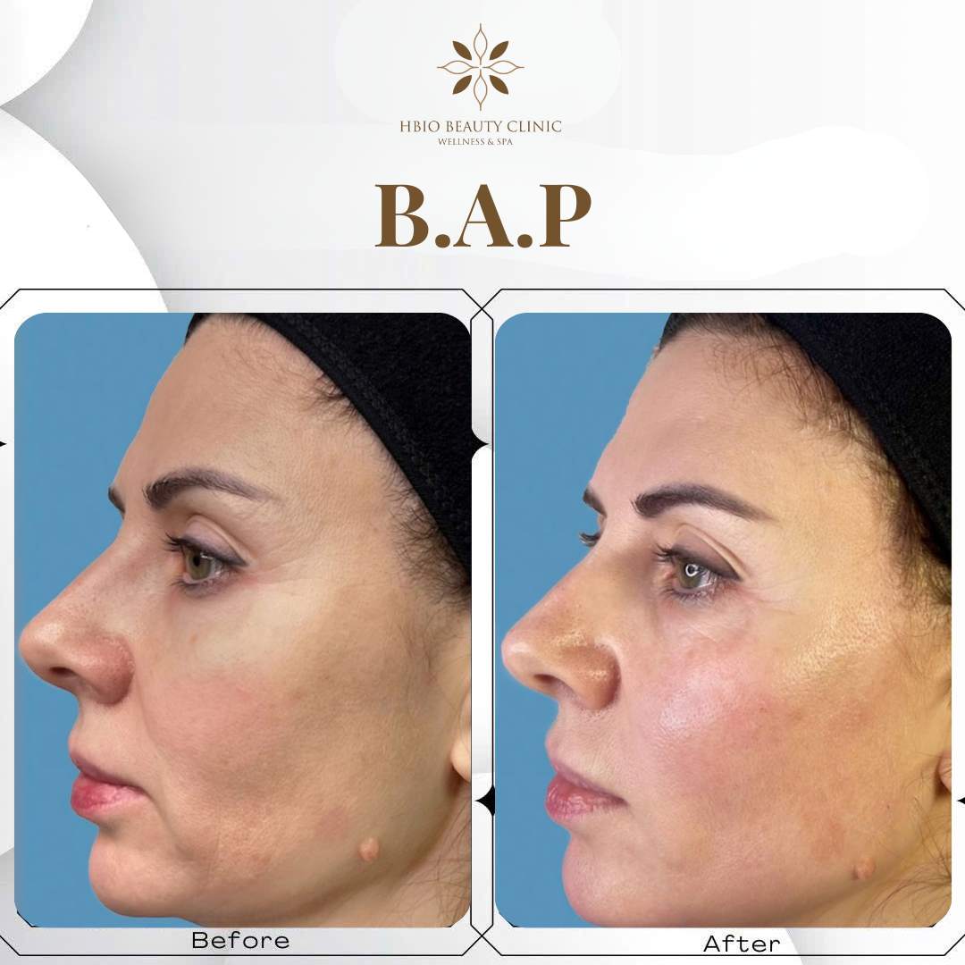 Khách hàng sau khi tiêm BAP