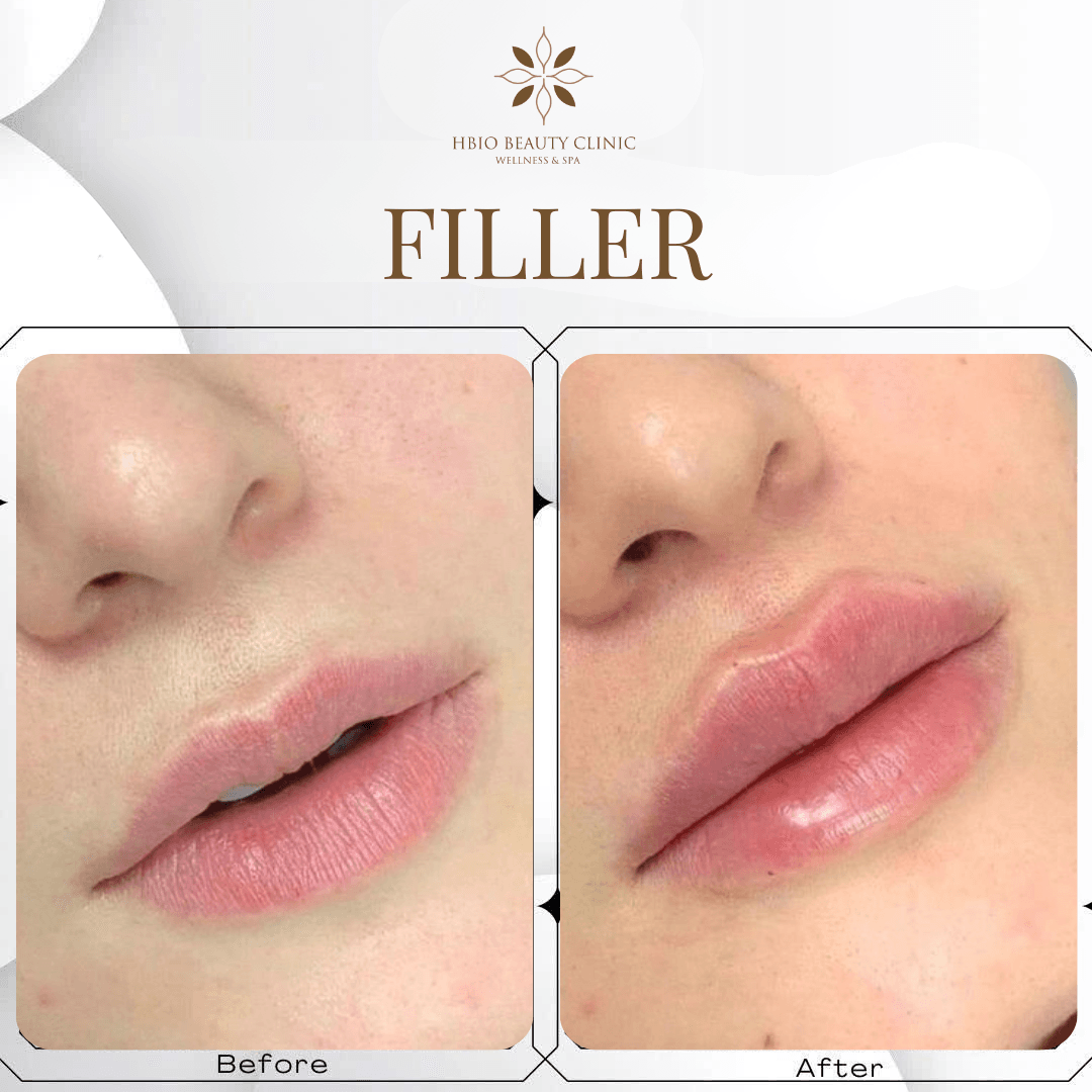 Benefits of lip filler injections