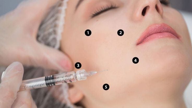 Phương pháp tiêm BAP 5 điểm được nhiều người lựa chọn