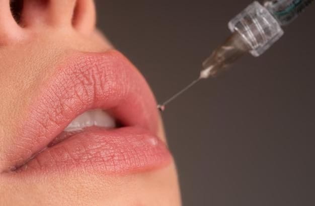 Quy trình tiêm filler môi tại HBIO Clinic