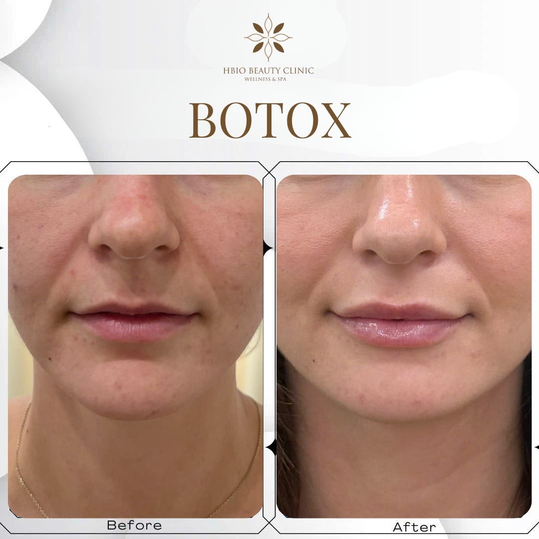 Tạo hình môi tự nhiên