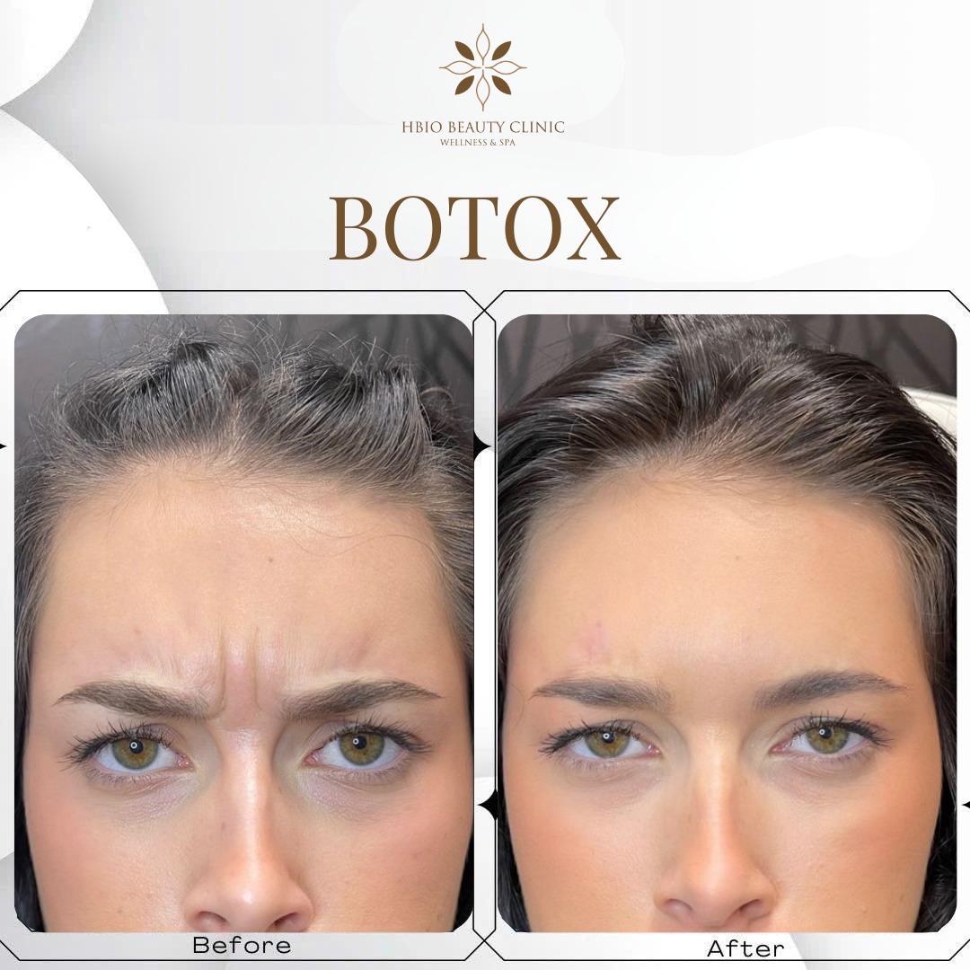 Tiêm botox giúp xóa nhăn cau mày hiệu quả