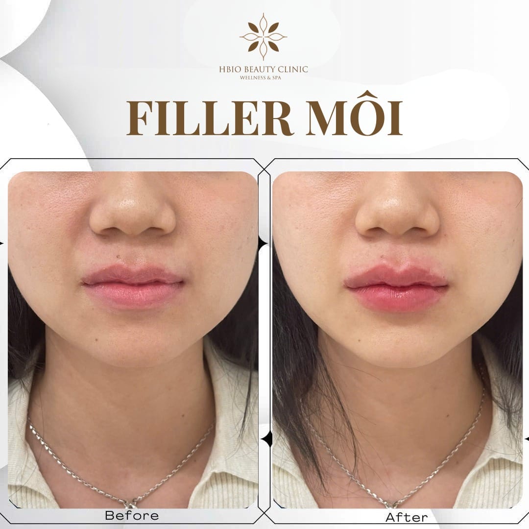 Tiêm filler môi giữ được bao lâu?