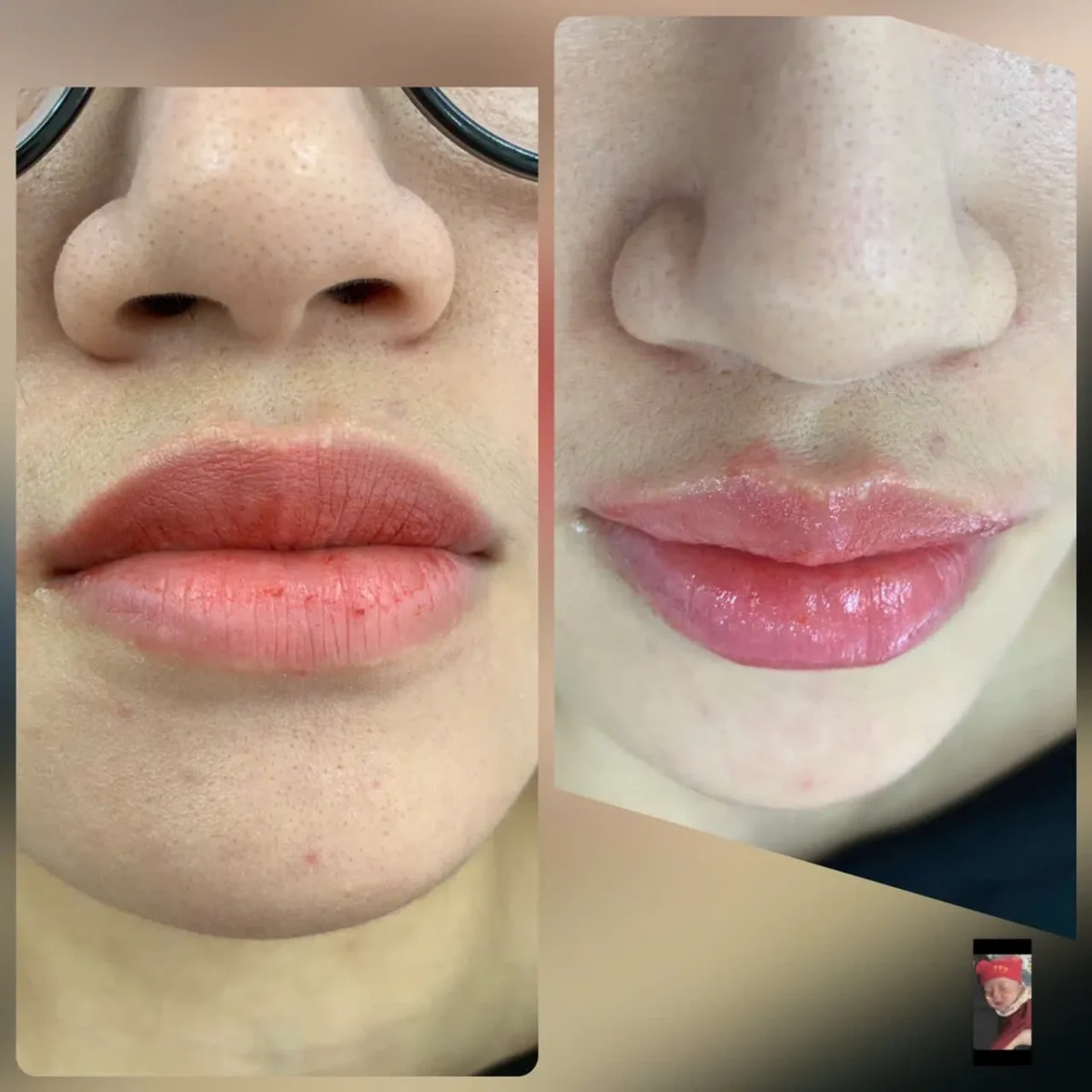 What is lip filler injection?