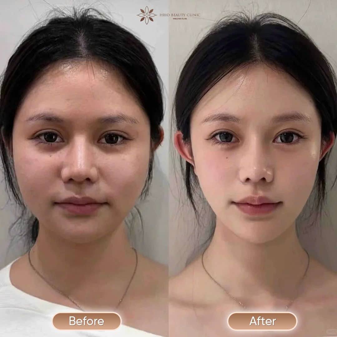 tiêm filler thái dương