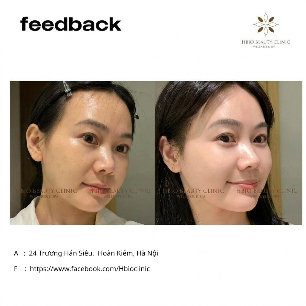Tiêm meso giúp cải thiện tình trạng da sần sùi