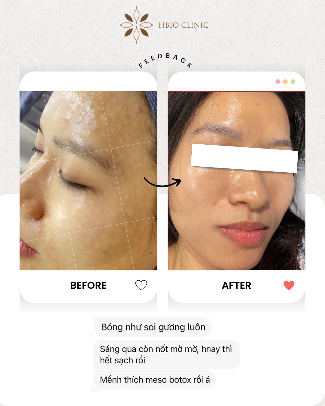 Khách hàng tiêm meso tại HBIO Clinic