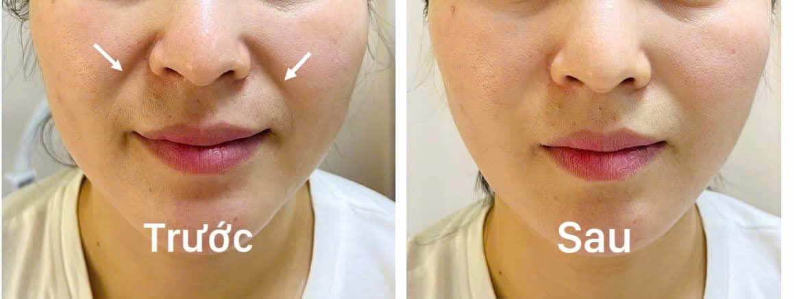 Ưu điểm của tiêm rãnh cười