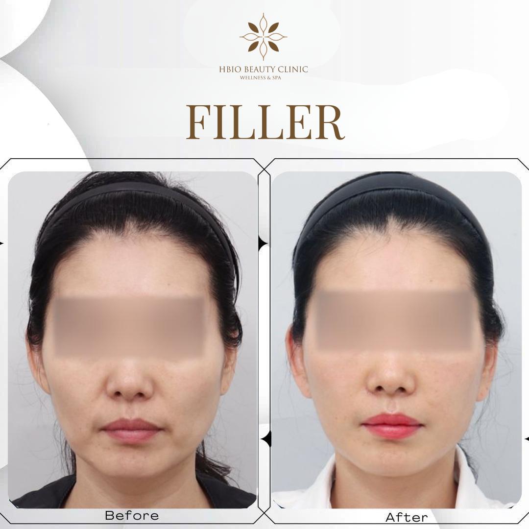 trước và sau khi tiêm filler má