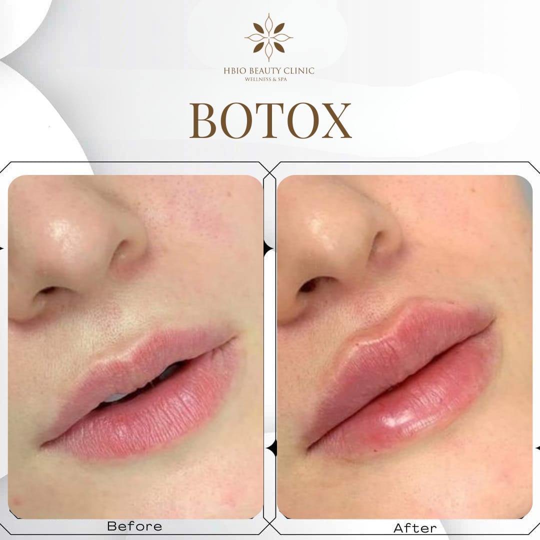 Ưu điểm vượt trội của phương pháp tiêm filler môi