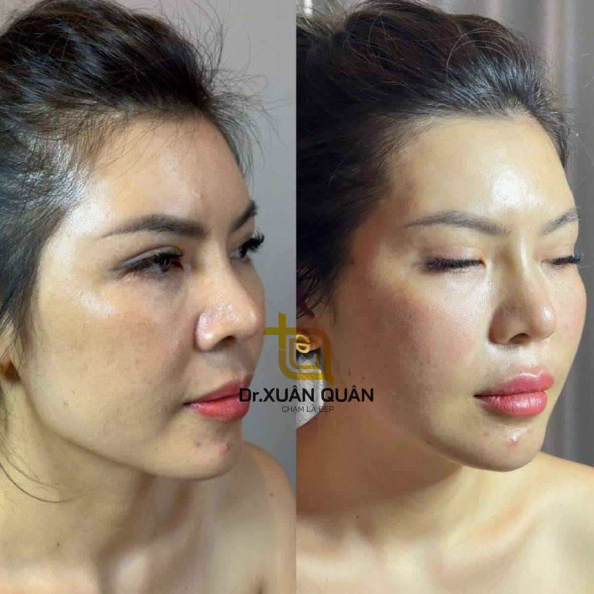 Outstanding benefits of lip filler injections