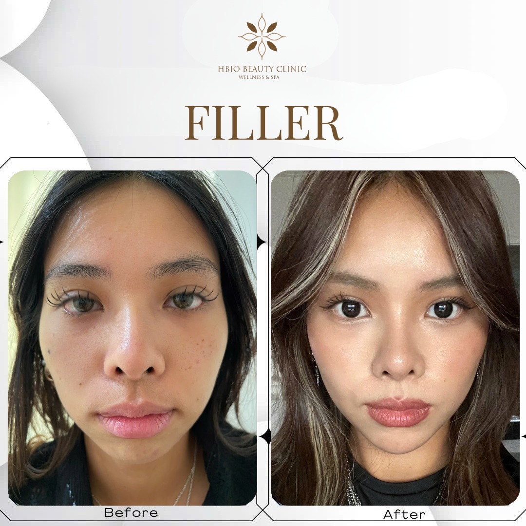 Tiêm filler cằm