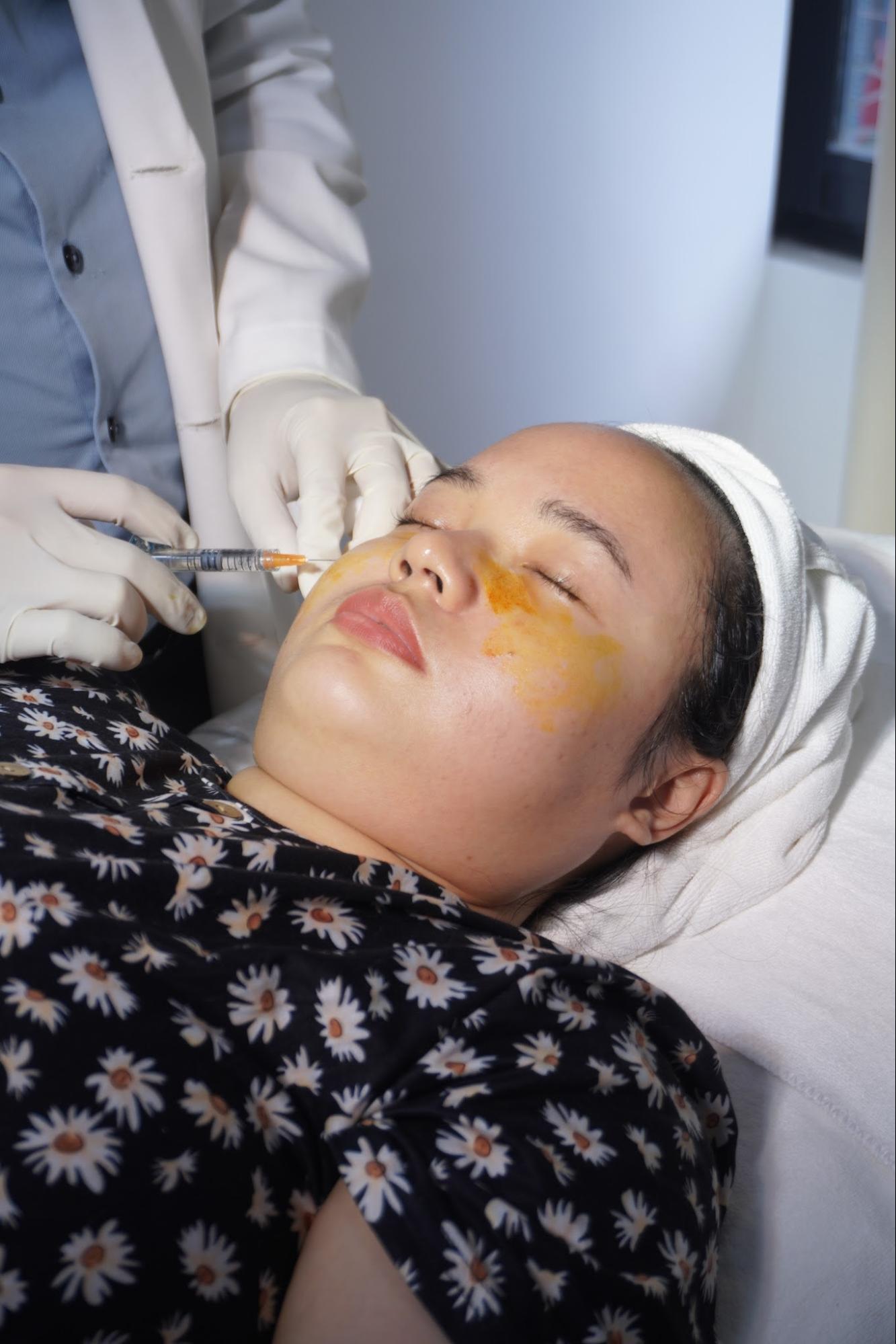 Tiêm filler vùng dưới mắt