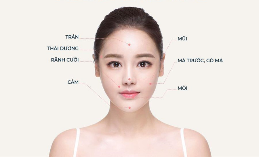 Các vị trí tiêm filler trên mặt