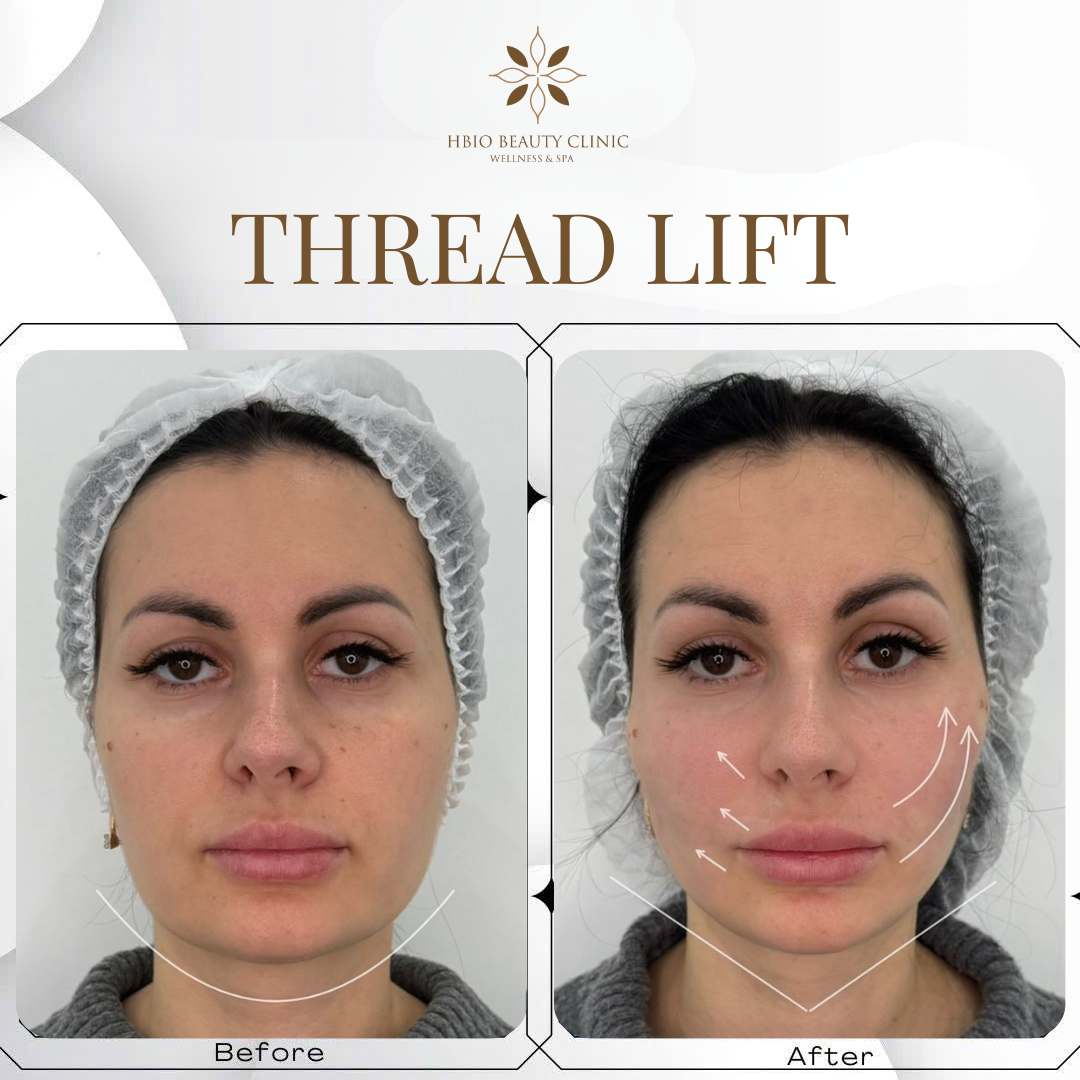 căng chỉ nâng rãnh miệng cằm