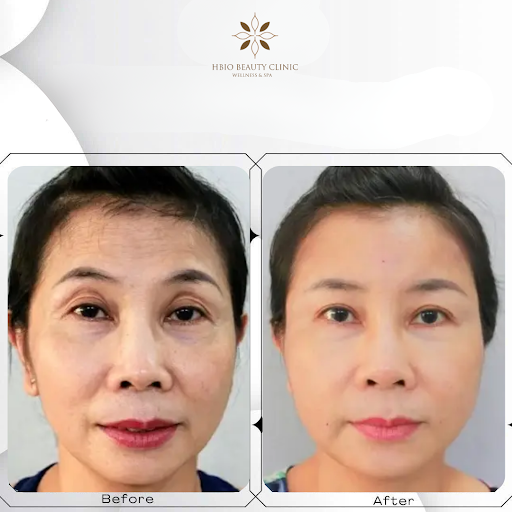 Hình ảnh trước và sau khi căng chỉ trán