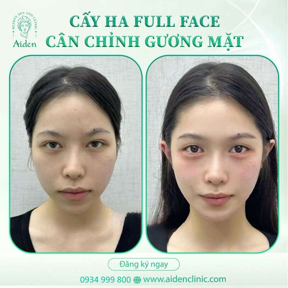 Chi phí tiêm filler trán tại Hbio Clinic