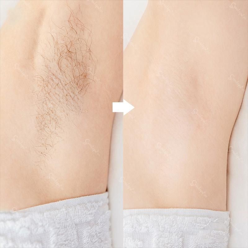 Chi phí công nghệ triệt lông Diode Laser