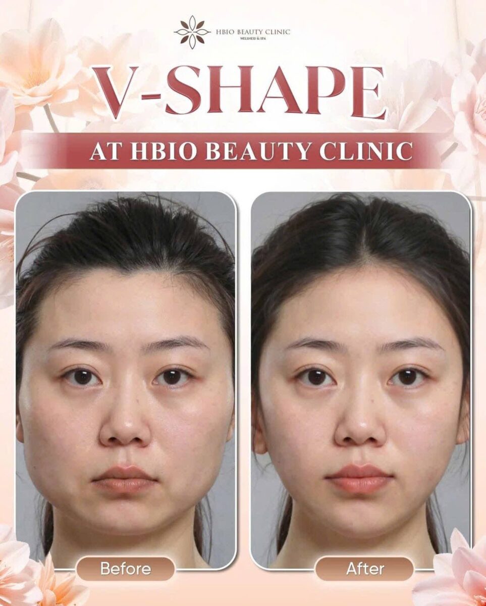 Ưu, nhược điểm của công nghệ HIFU