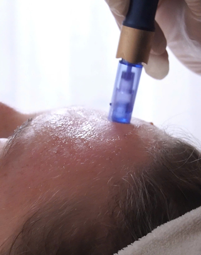 Quy trình điều trị bằng công nghệ skin pen