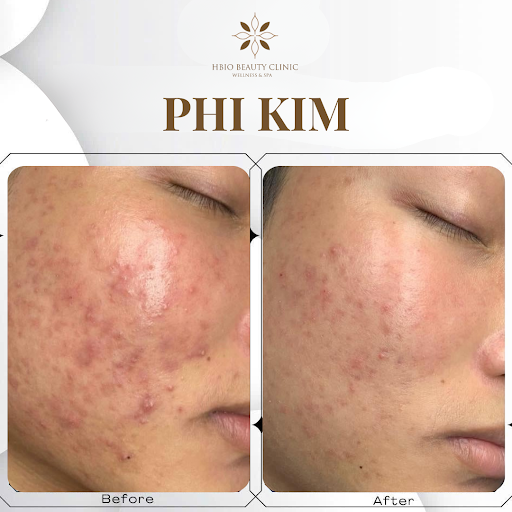 Hỗ trợ cải thiện tình trạng sẹo do mụn