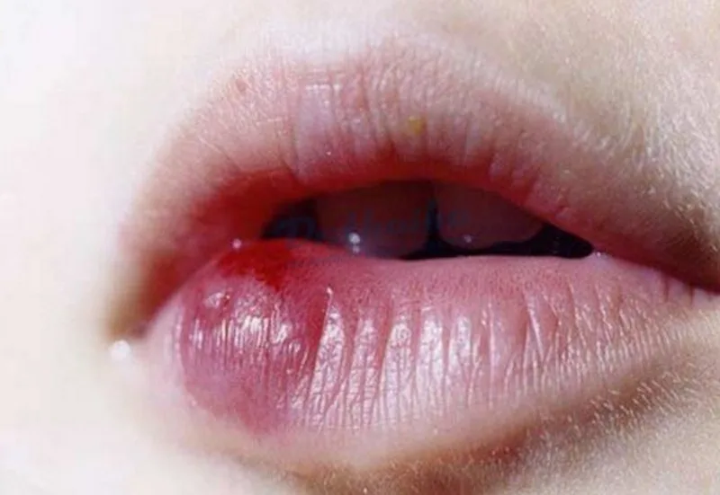 Tiêm filler bị vón cục có sao không? Cách làm tan filler vón cục hiệu quả