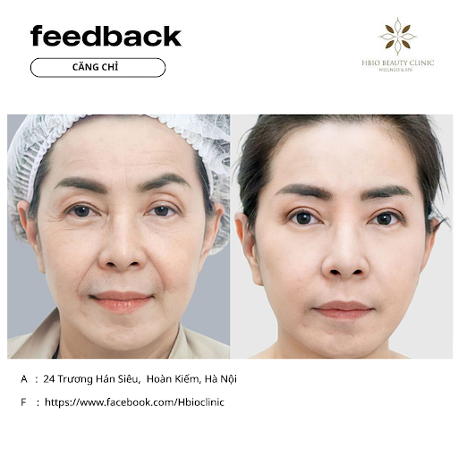 Hình ảnh điều trị trước sau