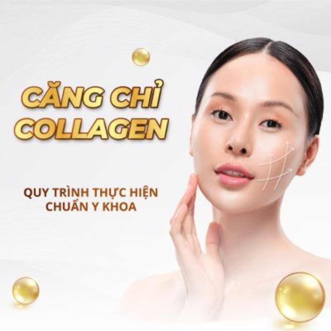 Căng chỉ rãnh cười tại Hbio Clinic
