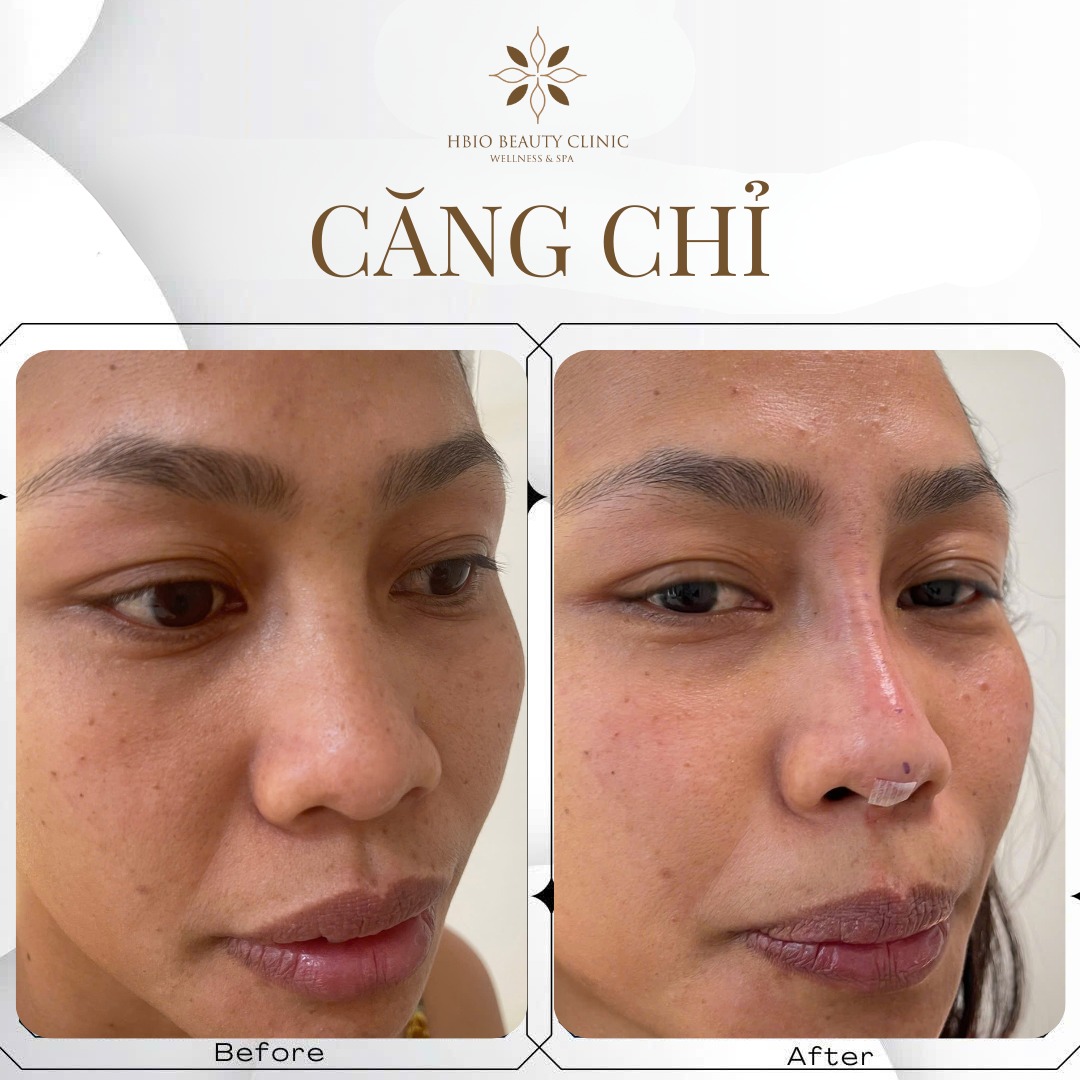 Hình ảnh trước và sau khi căng chỉ mũi