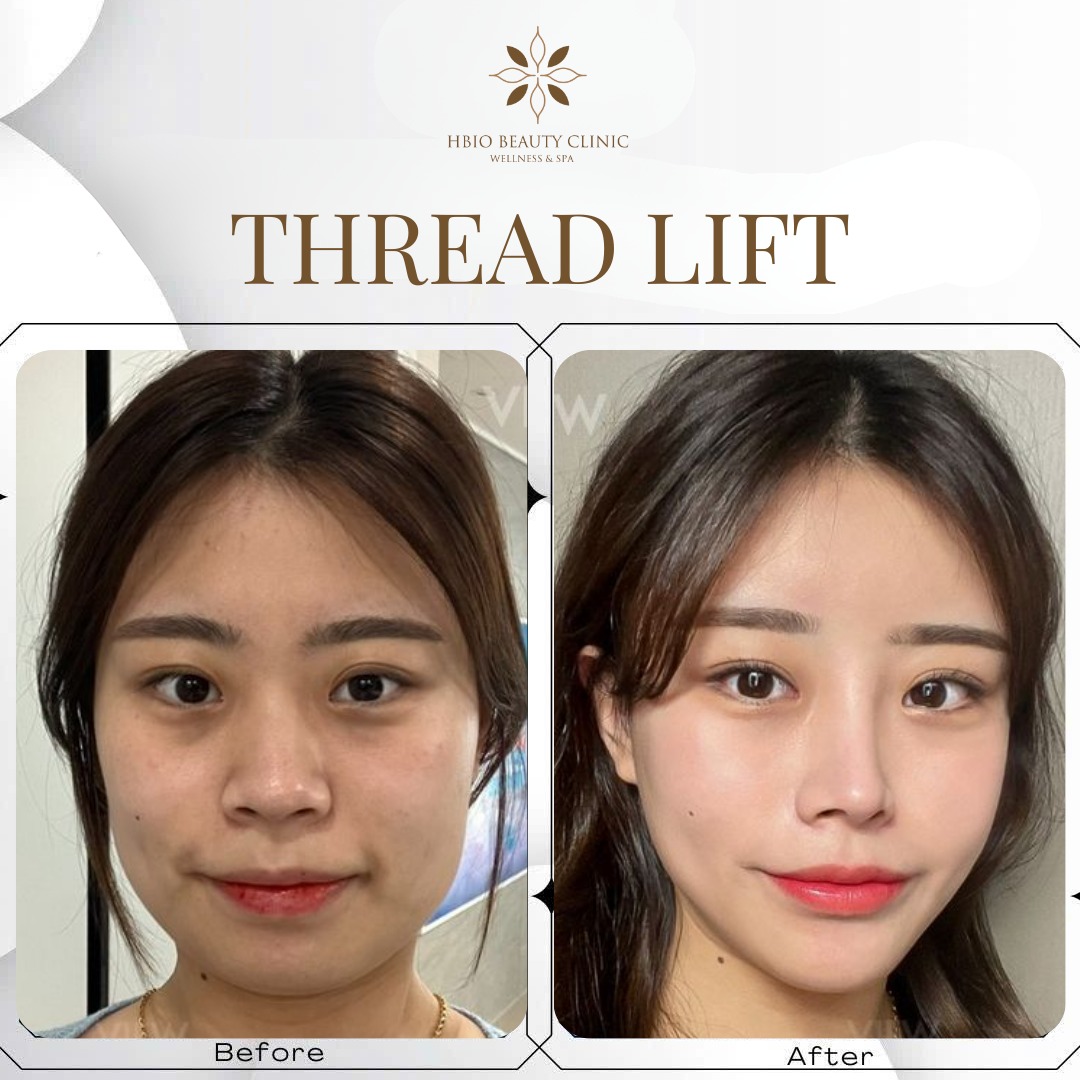 Hình ảnh trước và sau khi căng chỉ mũi