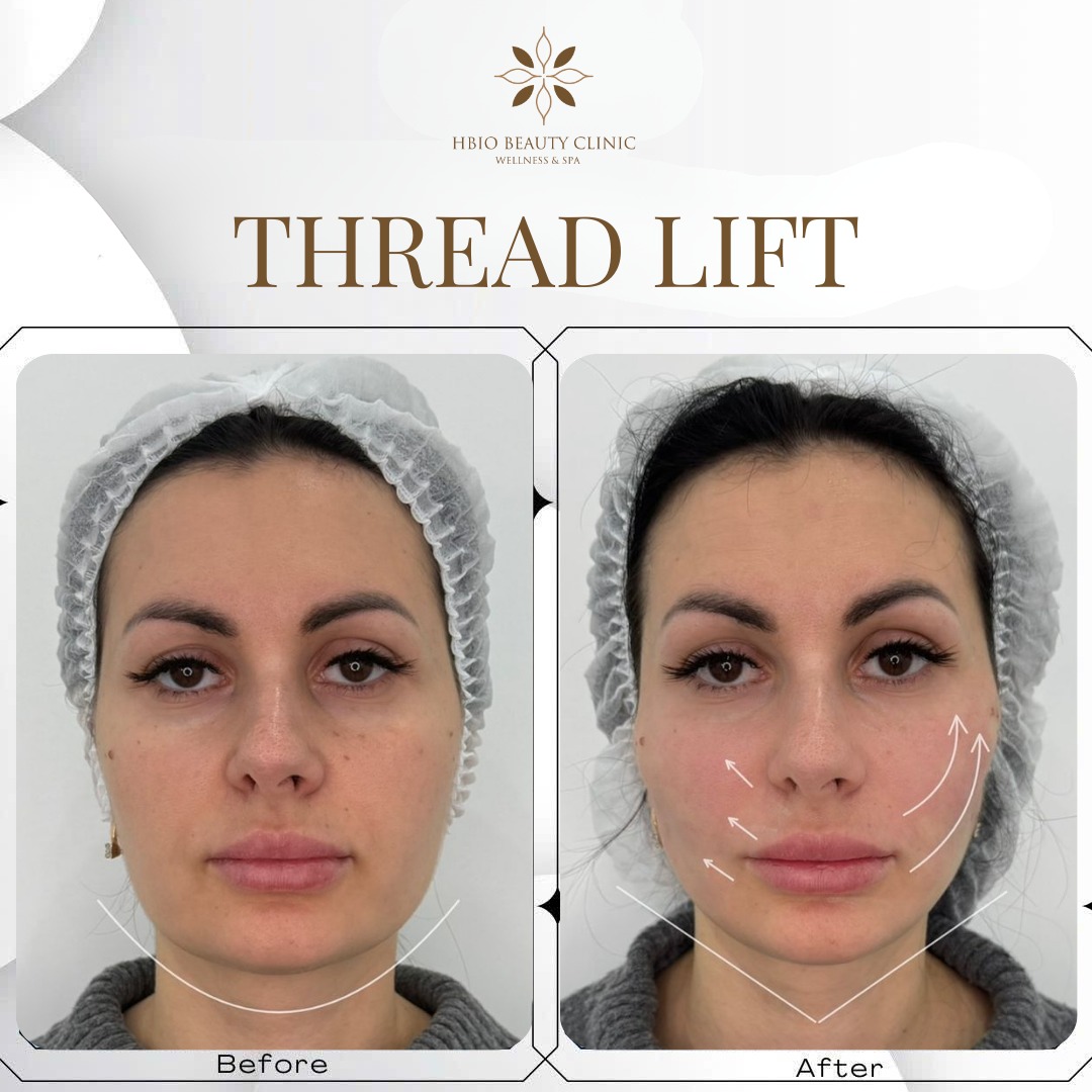 Hình ảnh trước và sau khi căng chỉ rãnh cười