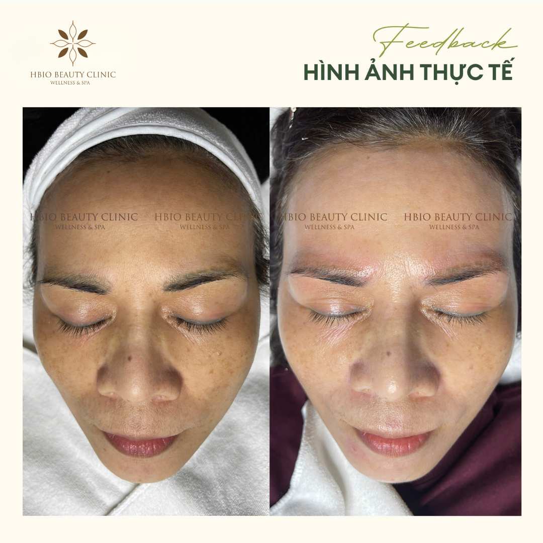 Khách hàng trước và sau khi điều trị bằng công nghệ laser pico