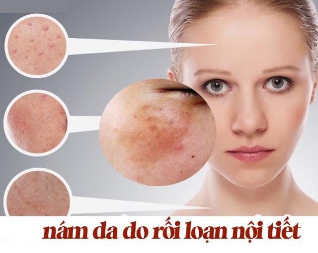 Thay đổi nội tiết tố là một nguyên nhân quan trọng gây nám da