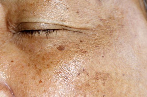Khi phụ nữ cao tuổi, sự thay đổi hormone và lão hóa làm da dễ bị nám hơn