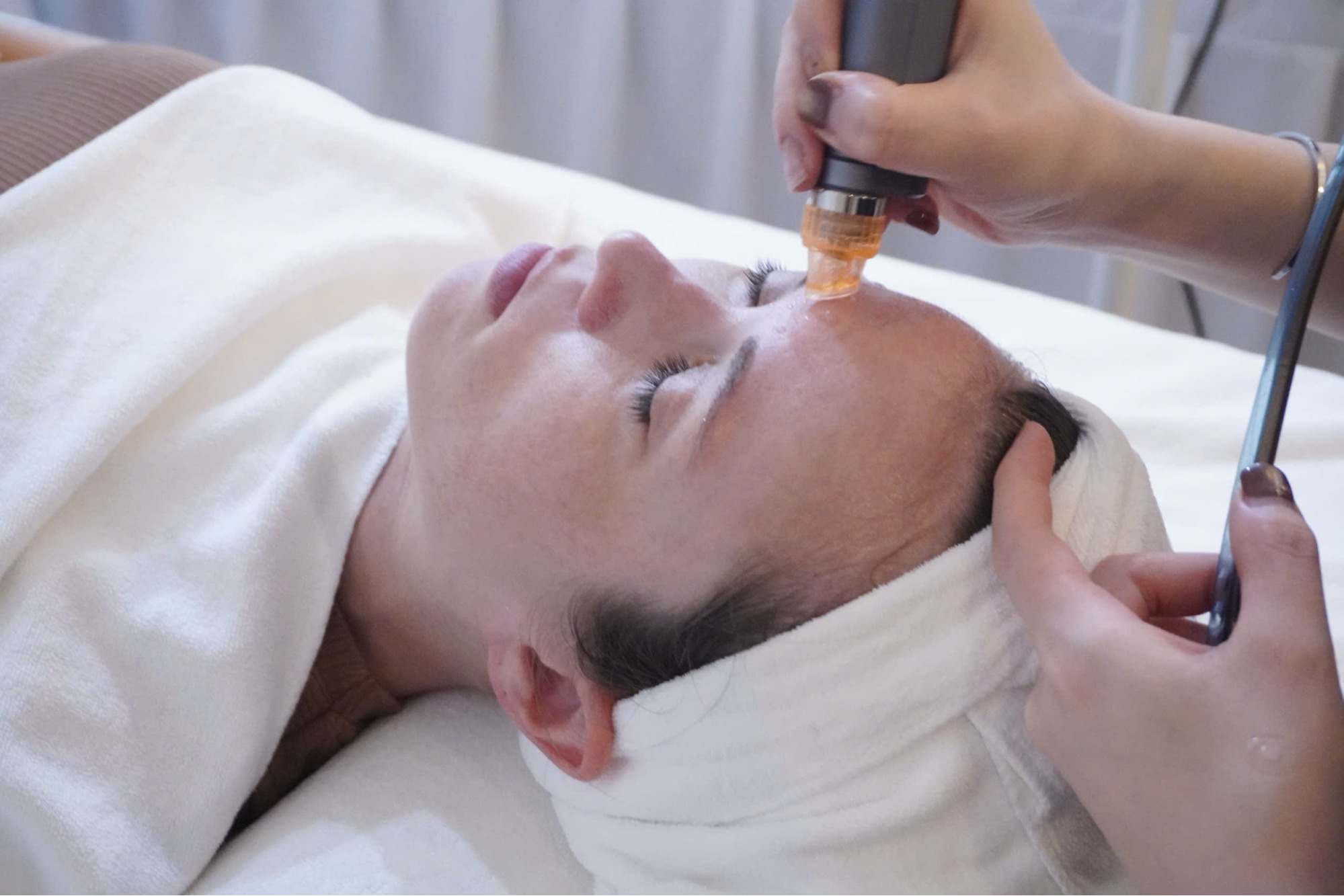 Phương pháp mài da vi điểm trong điều trị tăng sắc tối