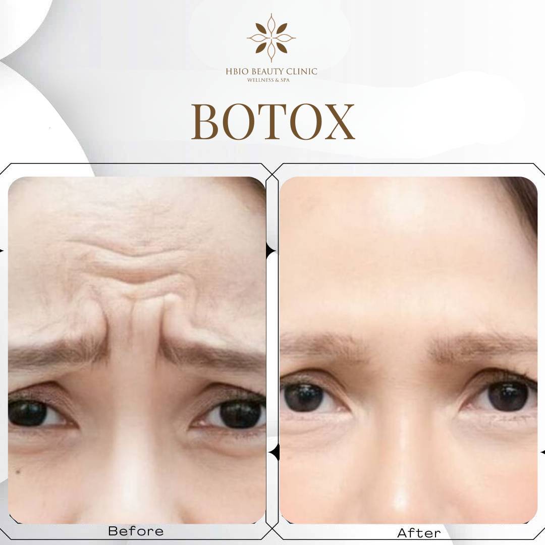 Tiêm botox xóa nếp nhăn ấn đường