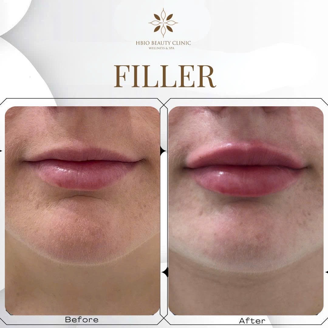 Tiêm filler bao lâu hết sưng?